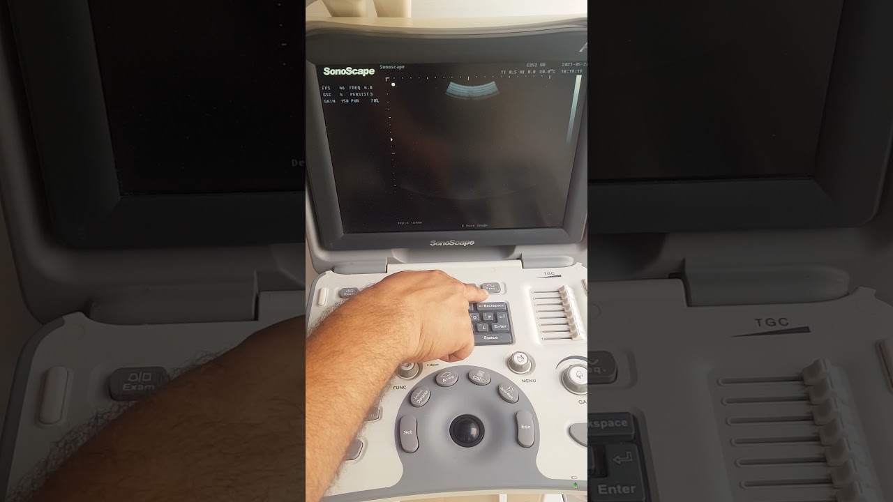 Sonoscape A5 VID1