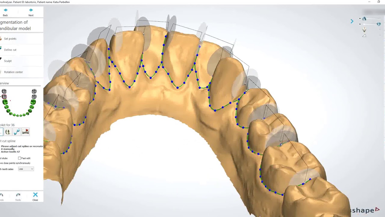 3Shape Ortho Analyzer - Tooth movement for invisible aligners