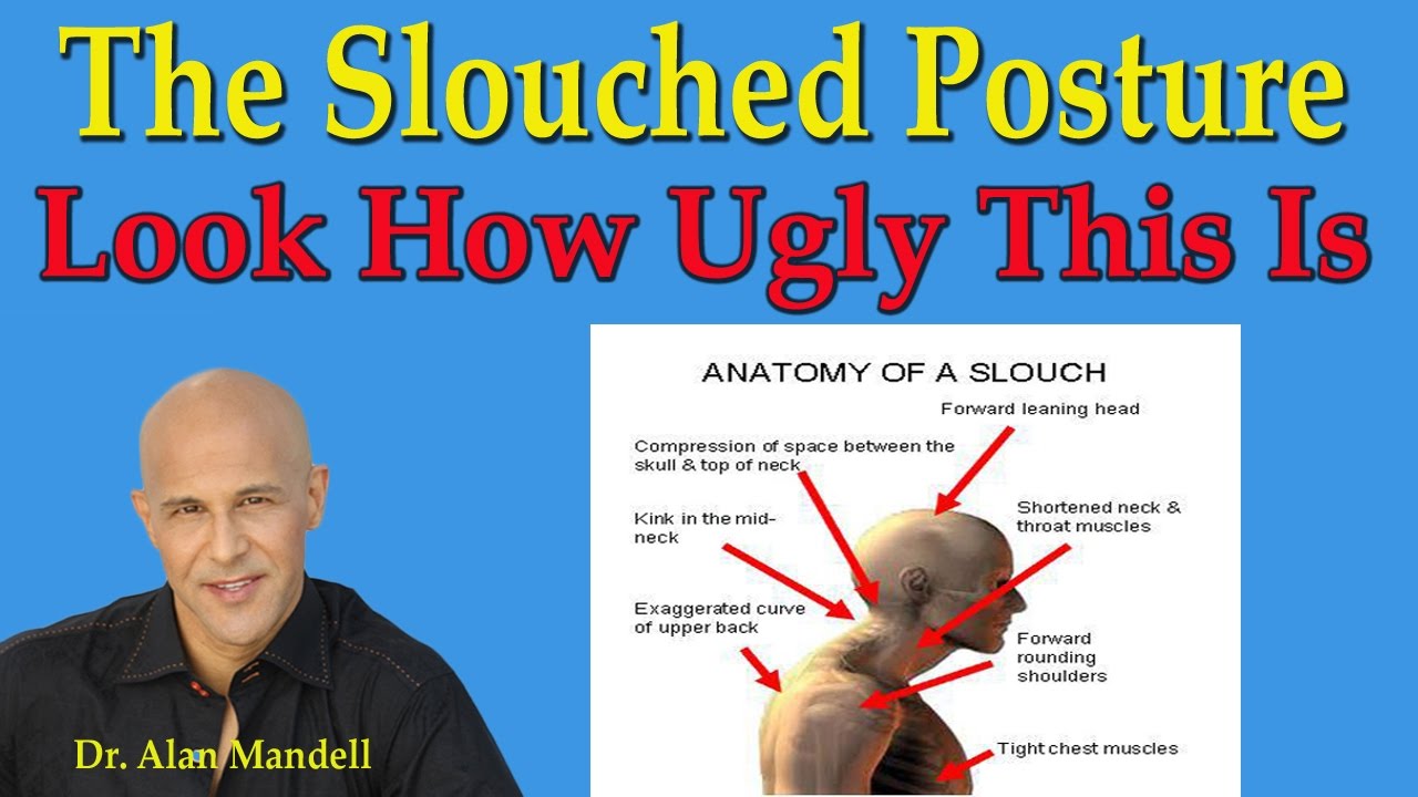 The Slouched Posture!   Look How Ugly This Is - Dr Mandell