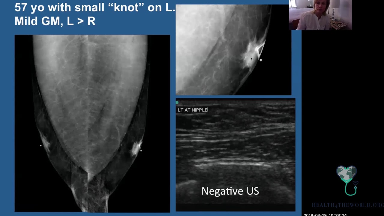 Imaging of the Male Breast - Part 4 | Health4TheWorld Academy