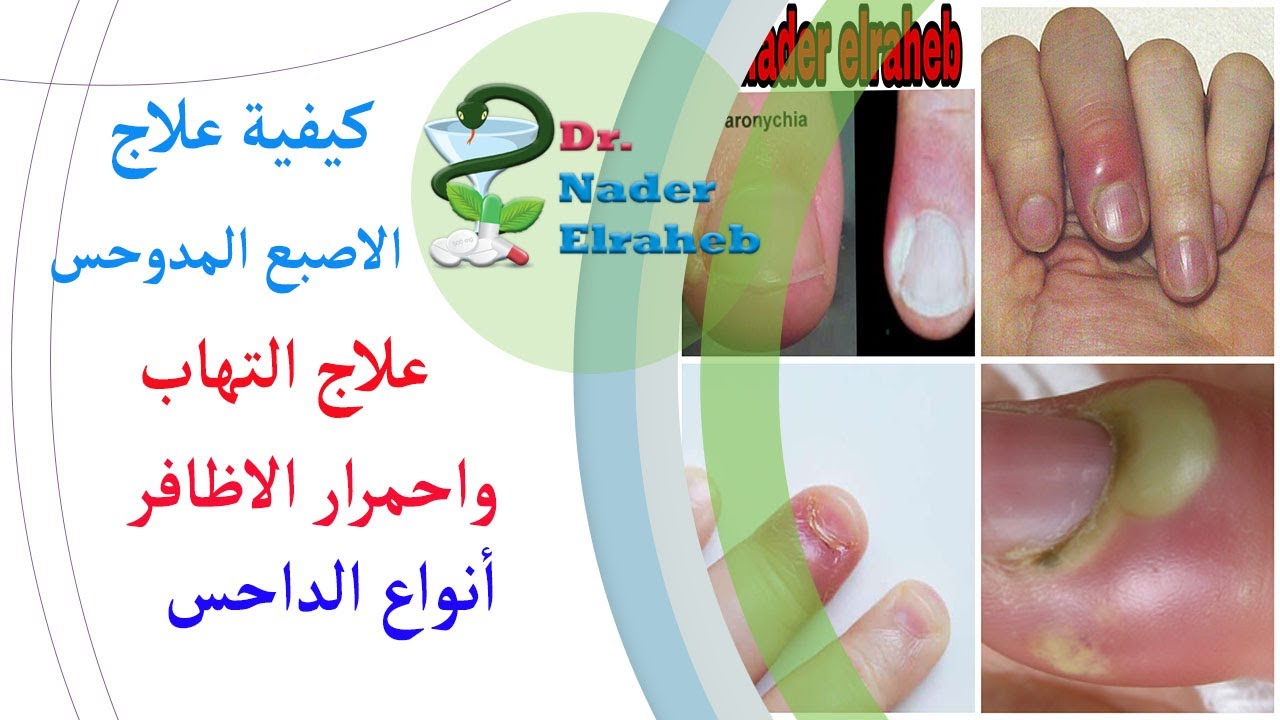 العلاج الفعال لتقيح مرقد الظفر والداحس الظفري في ظوافر القدم والايد|اعراض واسباب الداحس| Paronychia