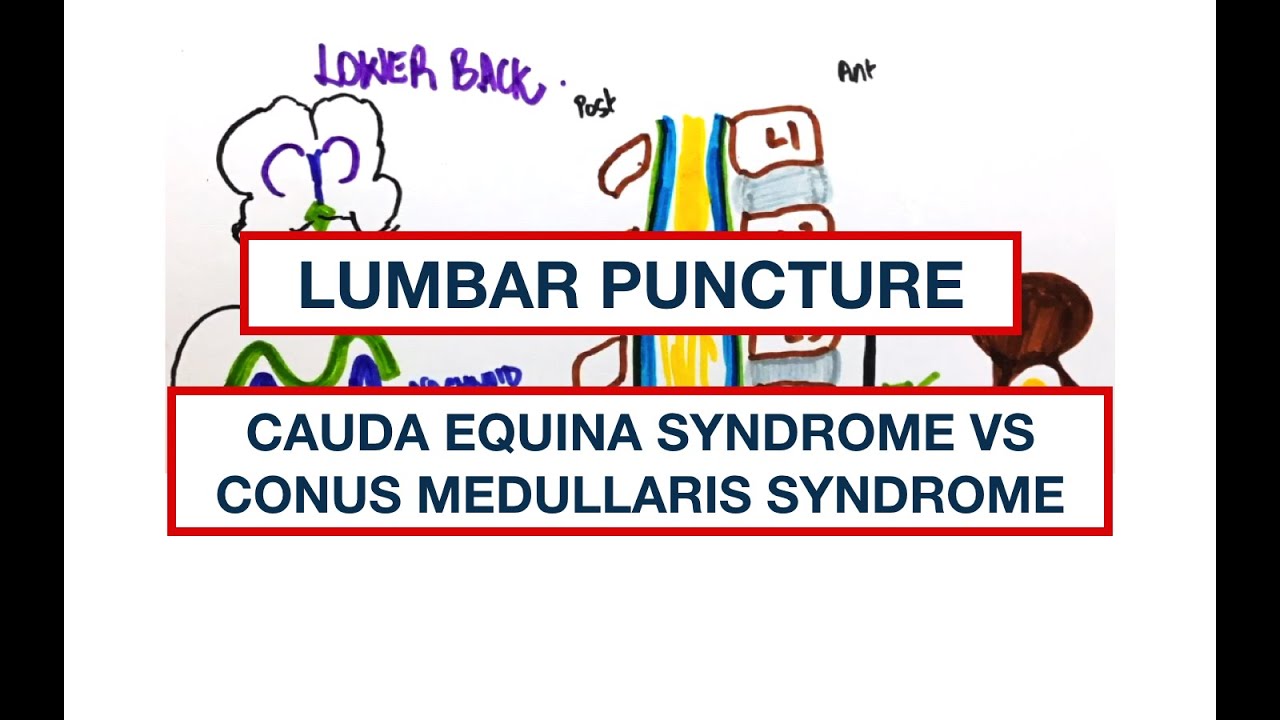 Lower back Anatomy: Lumbar Puncture, Cauda Equina Syndrome vs Conus Medullaris syndrome