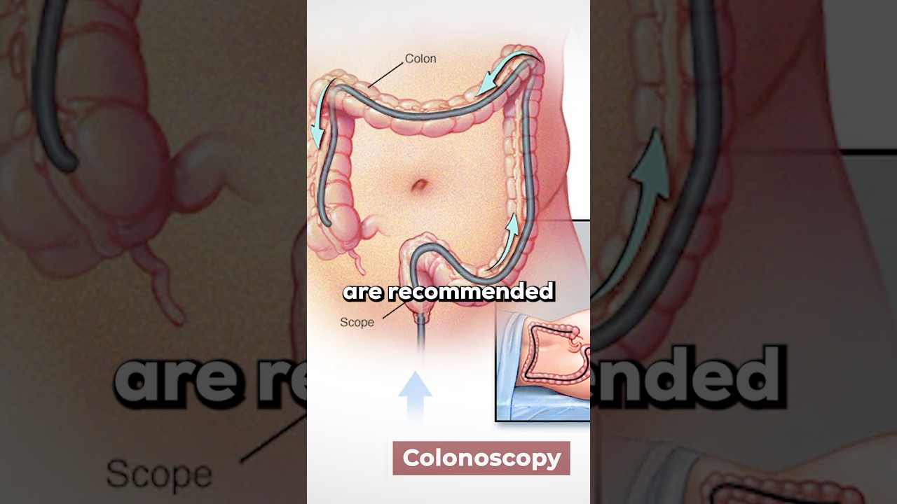 Colon Cancer: Who&rsquo;s At Risk?