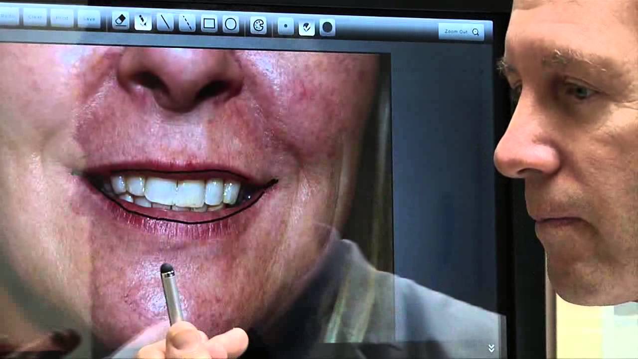 Lip Implants