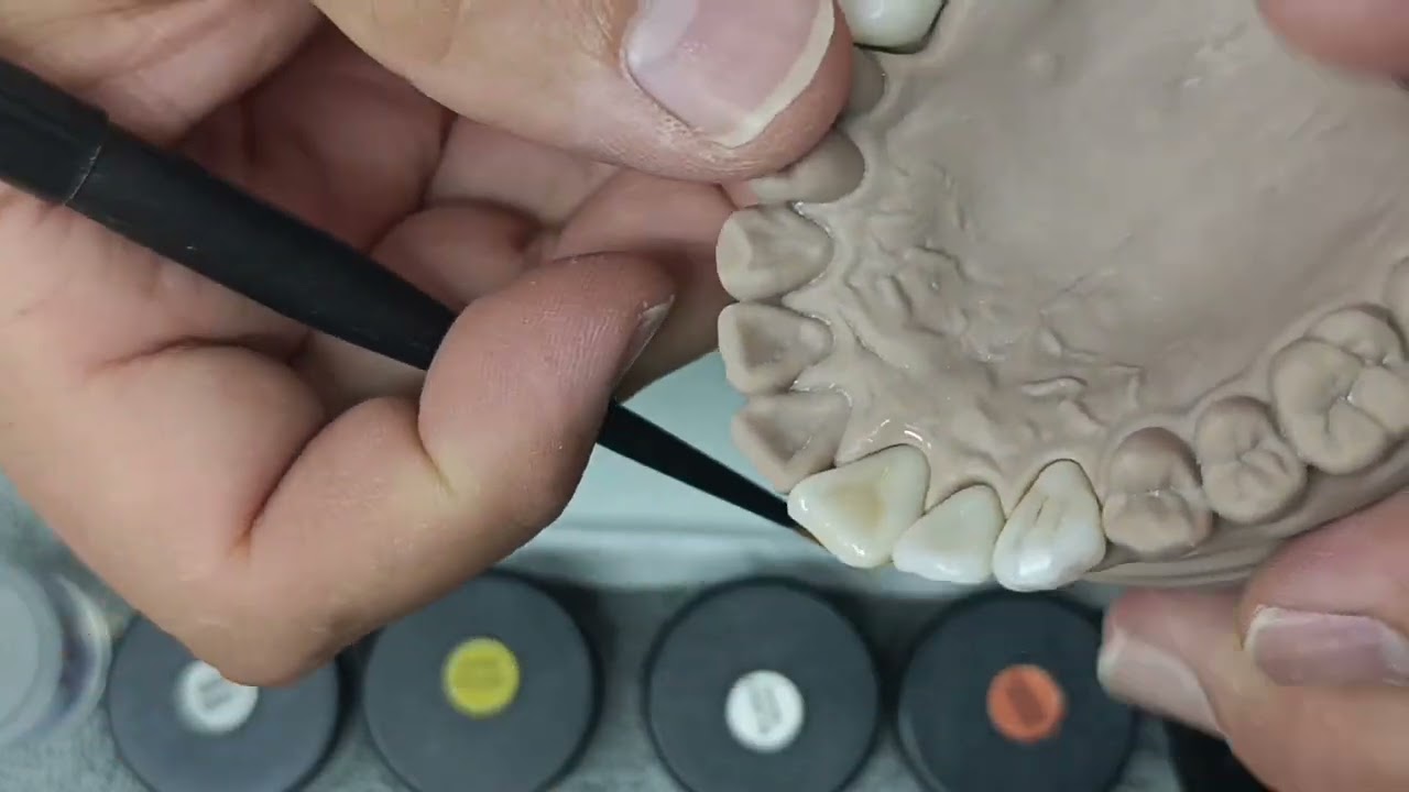 Maquillaje de Zirconia , usando Stain y Glaze Innovadent fácil y Rápido