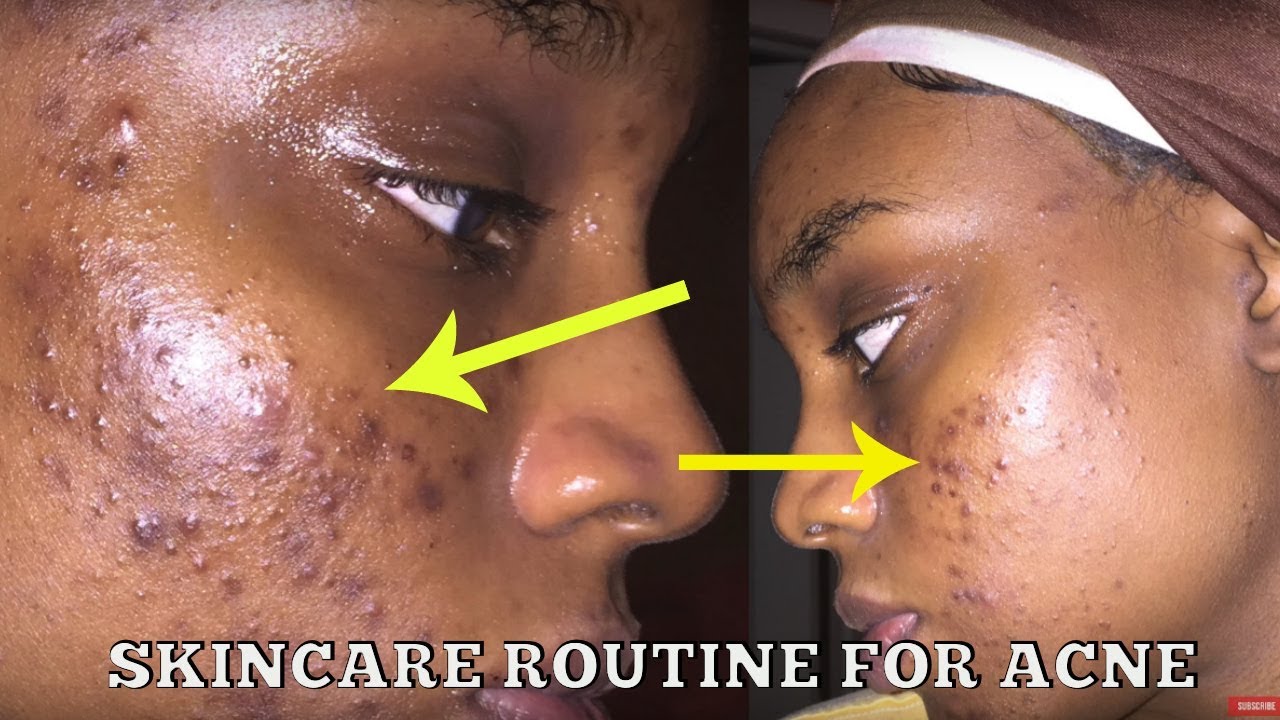 Skincare Routine For ACNE & DARK SPOTS  ➡  At Home Glow Peel!