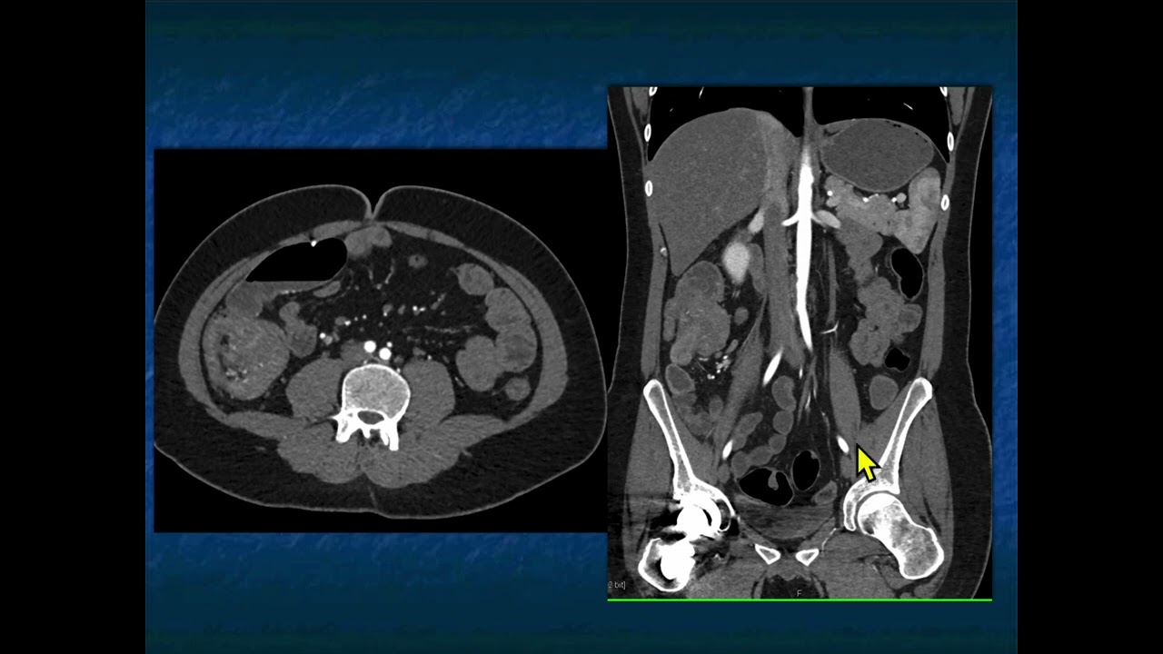 CT of Lymphoma: Involvement of the GI Tract - Part 2