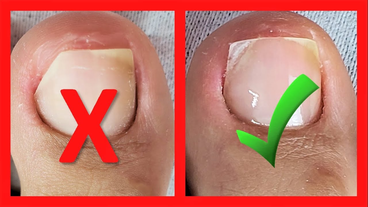 reconstruccion de uñas de pies con acrilico - nail reconstruction - reconstrução de unhas acrílico