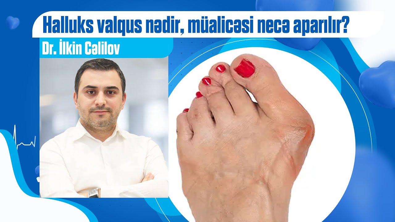 Halluks valqus nədir, müalicəsi necə aparılır?