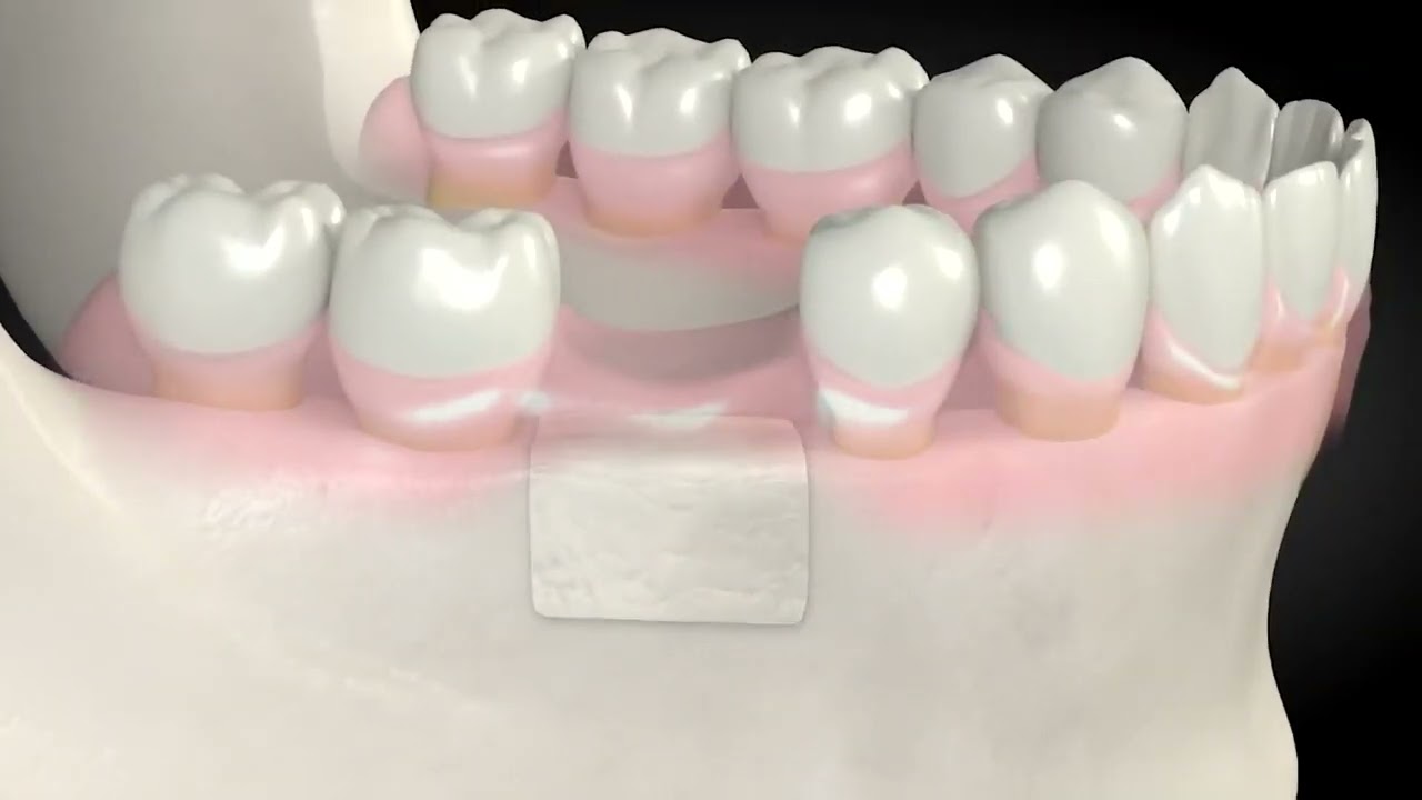 Bone Grafting Dental Centre Turkey Dental Centre Antalya Dental Hospital Turkey