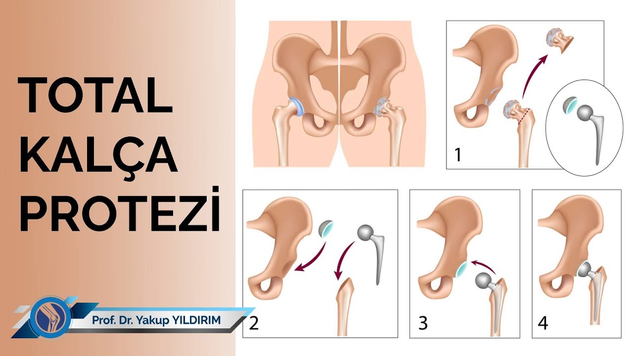 Total Kalça Protezi | Prof. Dr. Yakup YILDIRIM