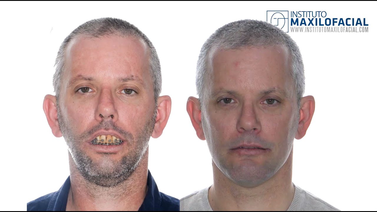 Cirug&iacute;a ortogn&aacute;tica bimaxilar. Mentoplastia. Caso #56: Roberto - Clase 2, Biretrusi&oacute;n