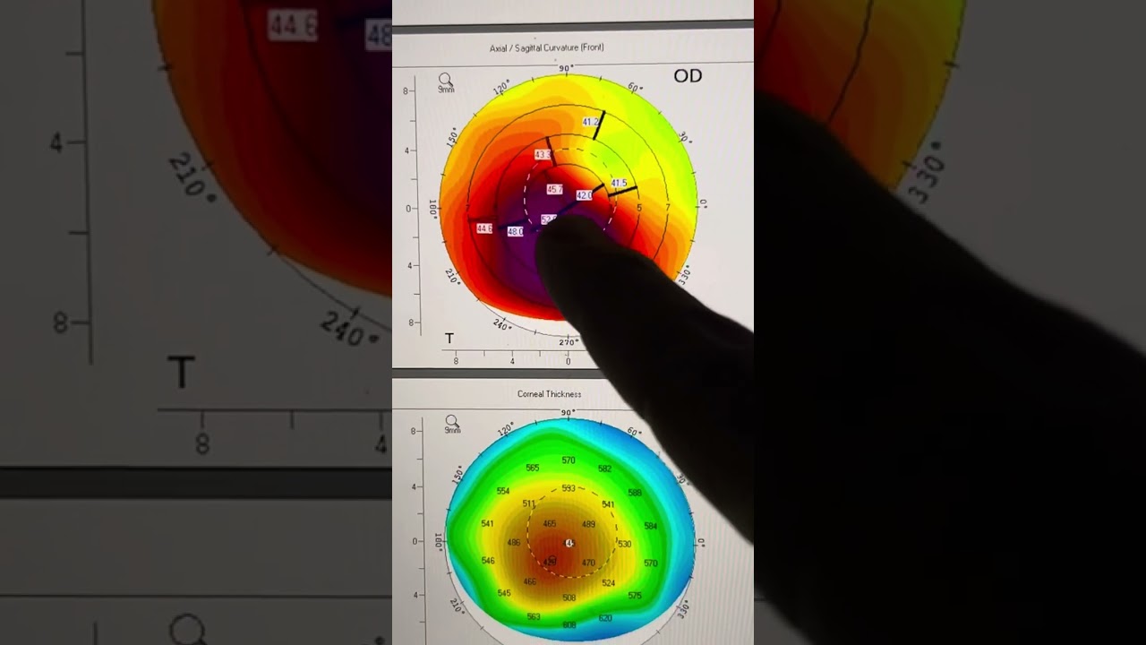 Planning an AthensProtocolCXL(topoguided surface ablation) case for keratoconus: Kanellopoulos, MD