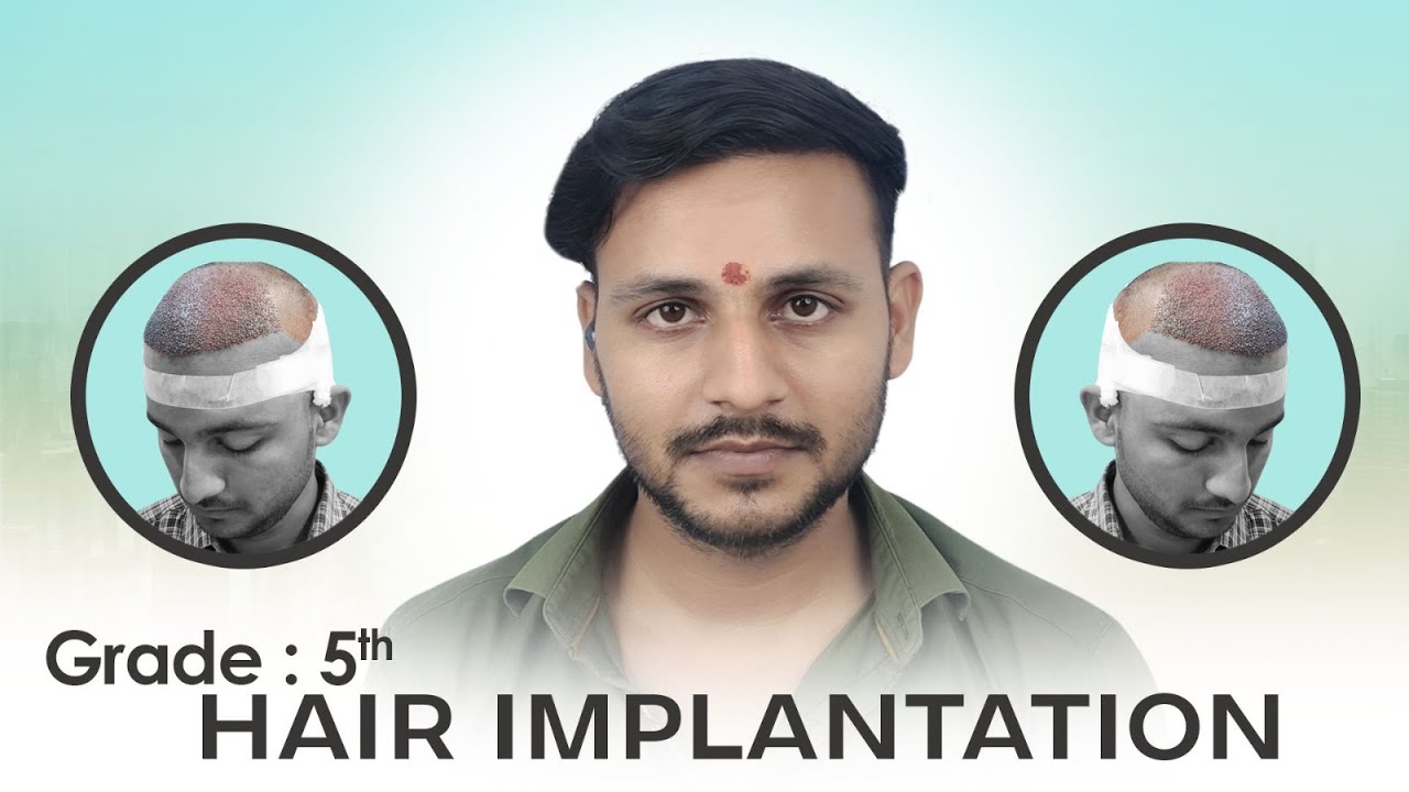 Incredible Hair Transplant Transformation | La Densitae Lucknow | Before & After Results!