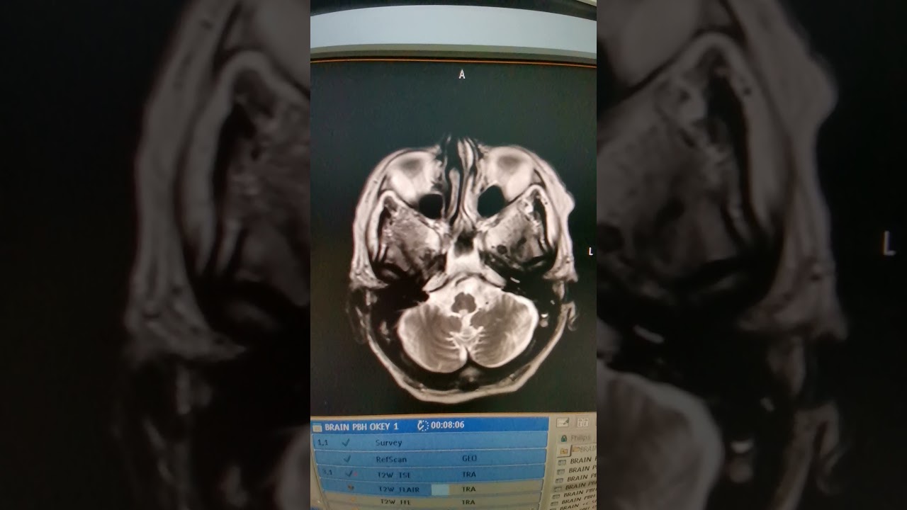 BRAIN MRI