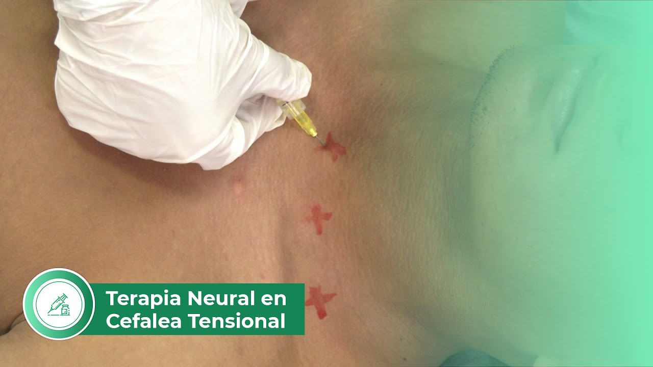 Aplicación de Terapia Neural en Cefalea Tensional: ¡Alivio Efectivo! 💆‍♀️✨🩺
