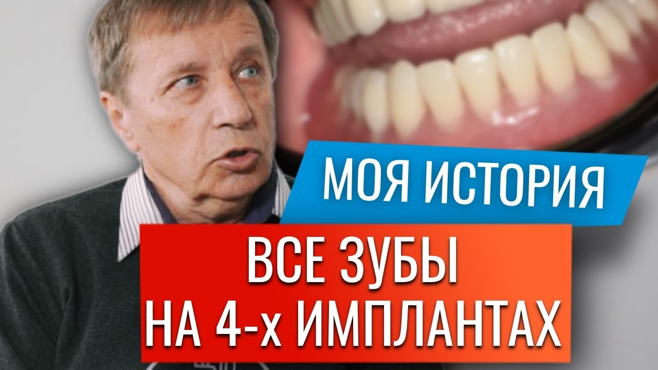 Видео отзыв, All on 4 альтернатива, протезирование всех зубов до/после. Стоматология в Ставрополе.