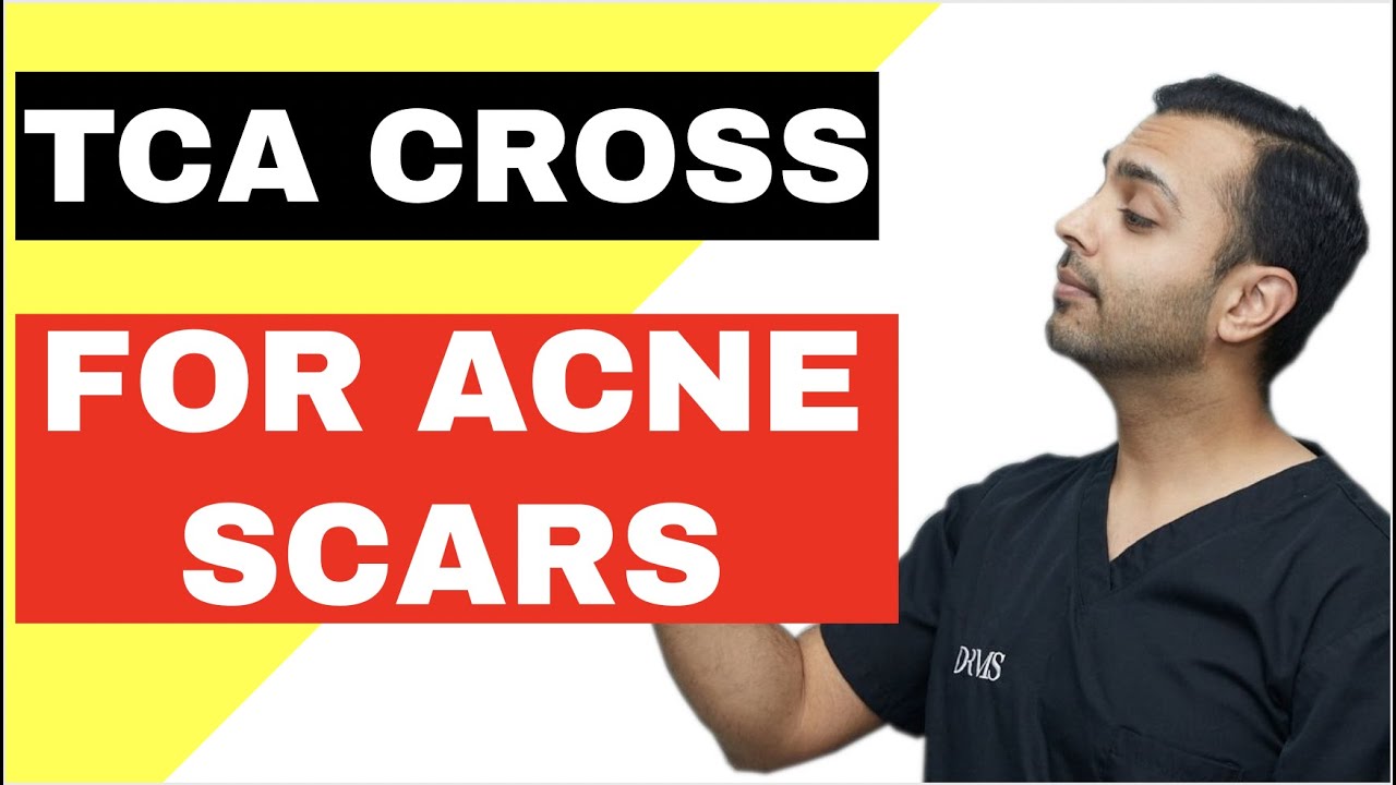 What Is TCA Cross Acne Treatment? | DrMediSpa