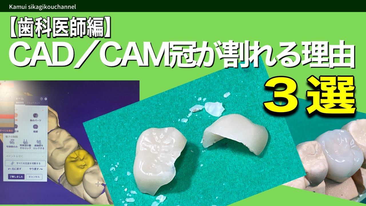 【歯科医師編】CAD／CAM冠が割れたり外れたりする支台歯形態や接着操作3選