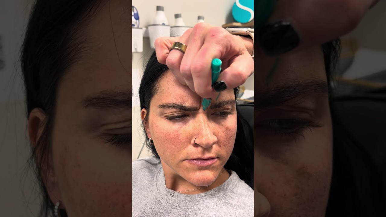 Botox Injections with some anatomy talk! - Smiley Aesthetics