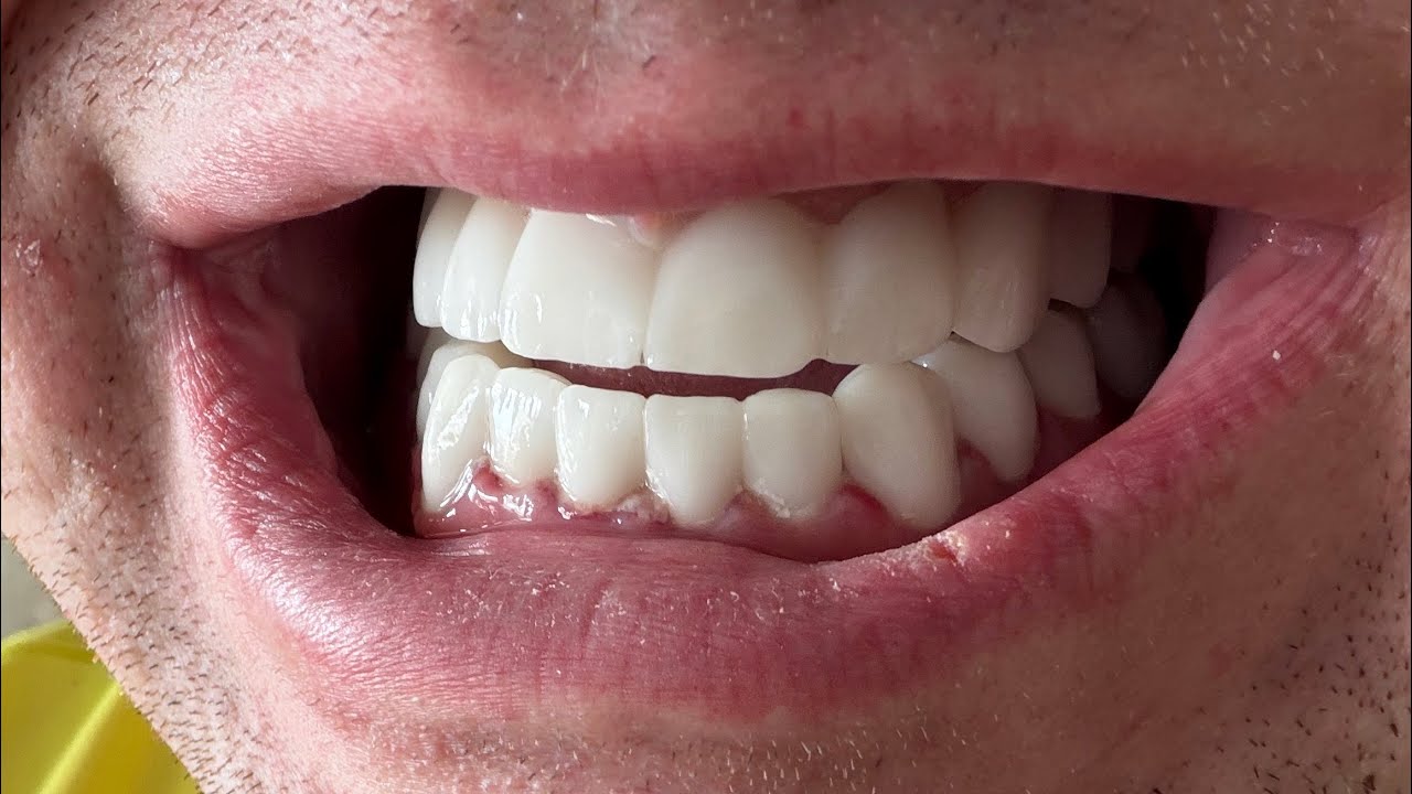 Мой опыт лечения индейских зубов