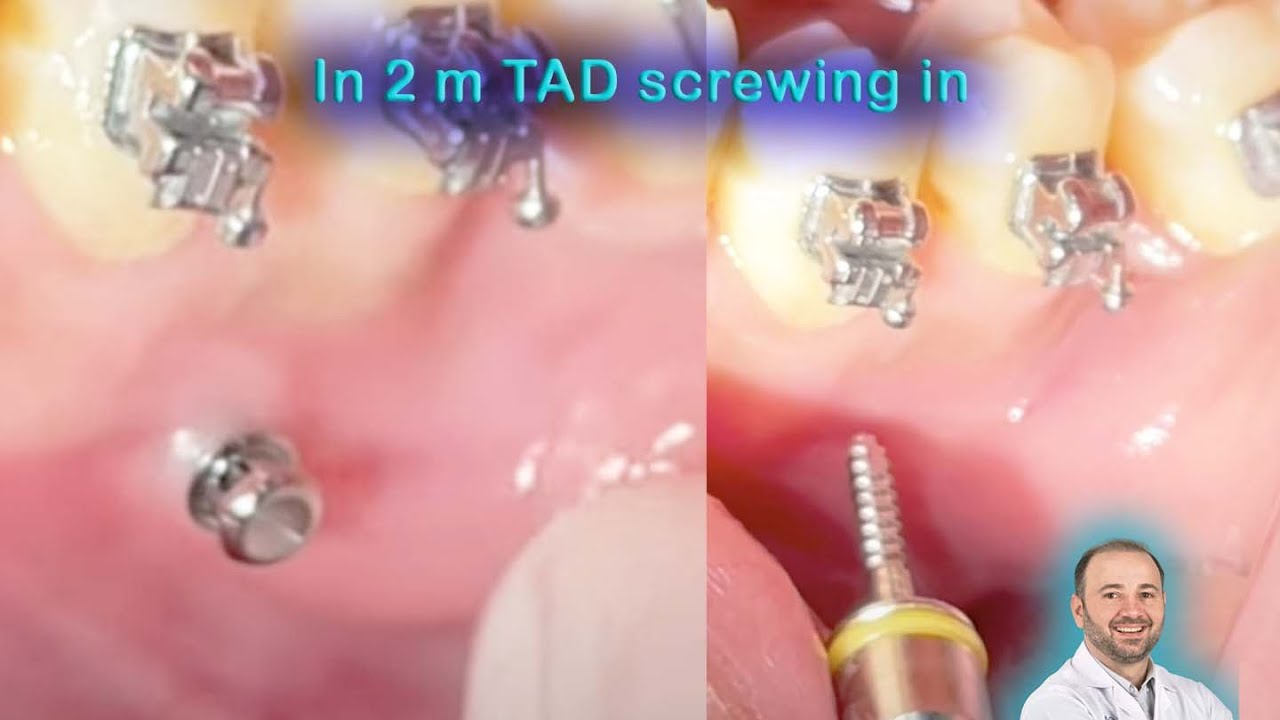 Interradicular TAD insertion between lower premolars, screwing in mini screw in the lower jaw