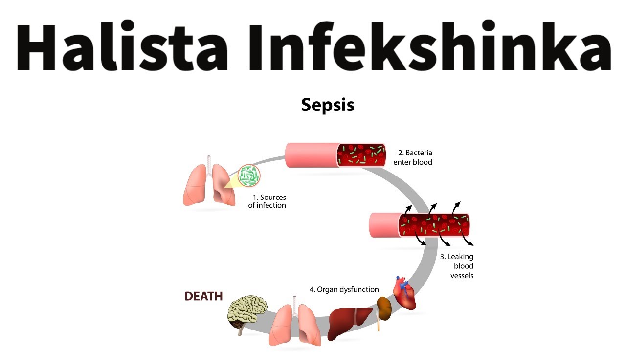 Wax ka Ogow Halista Infekshinka | Signs and Symptomps of Sepsis & Septic Shock | Somali Bridge - WA