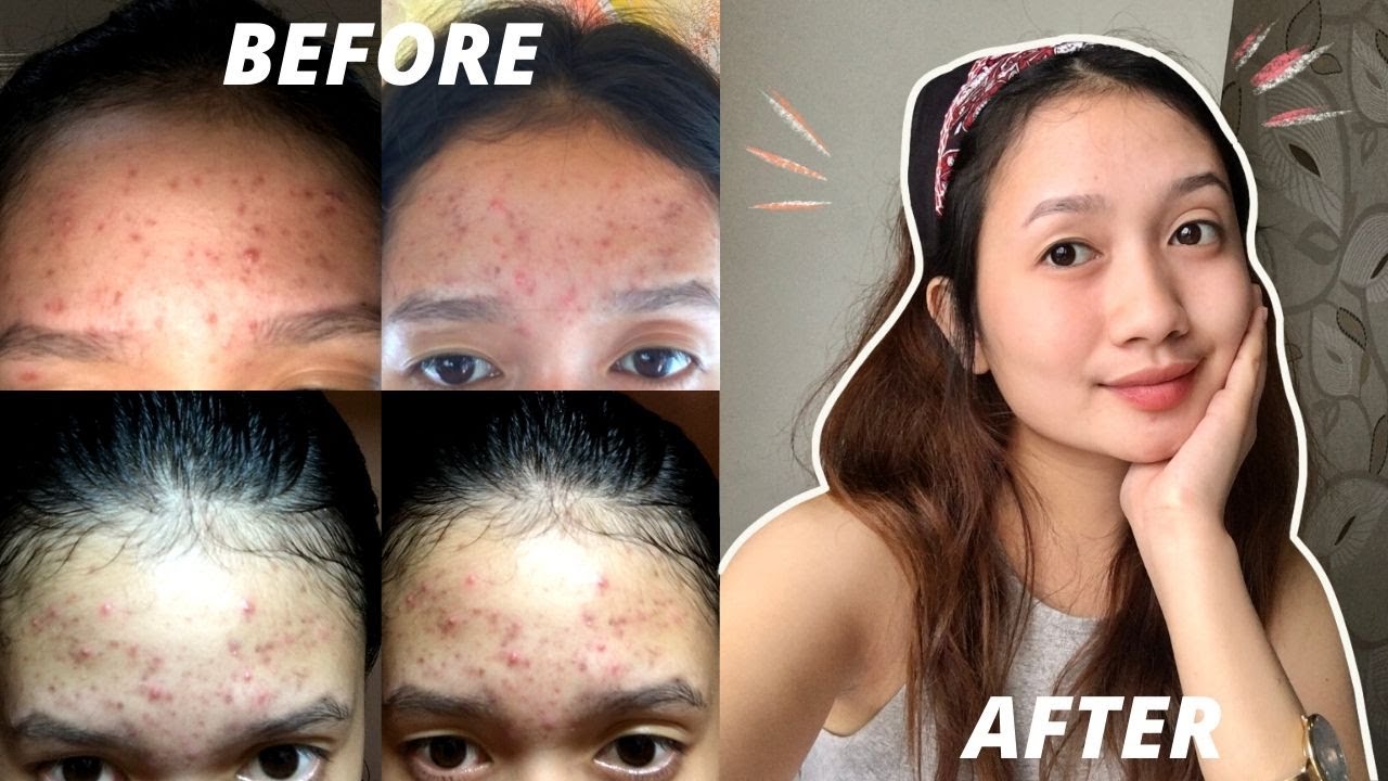 HOW I FINALLY GOT RID OF MY ACNE & SCARS (fast and affordable skincare) 2020 PHILIPPINES
