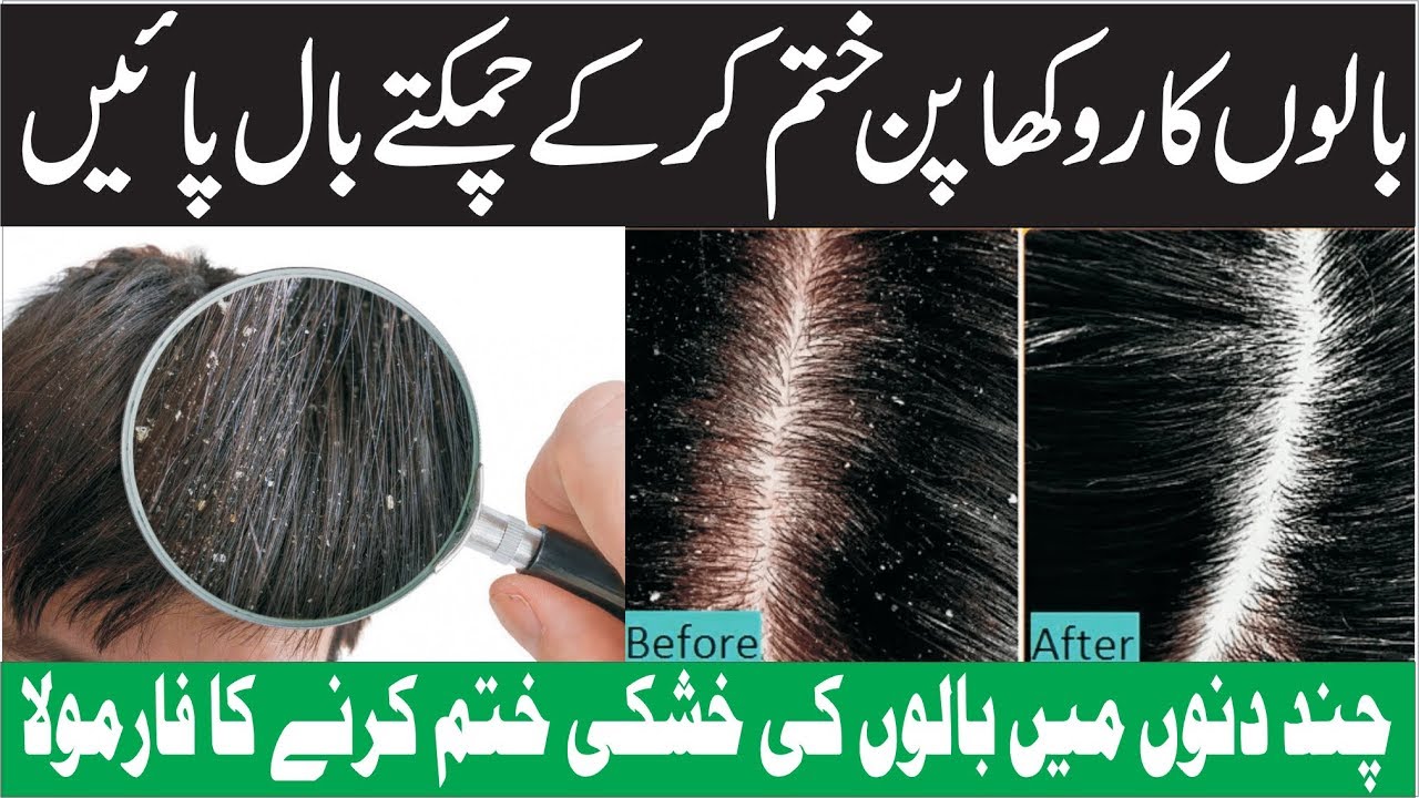 Easy Dandruff Treatment Get Silky and Shine Hairs | TIPS BY JIA