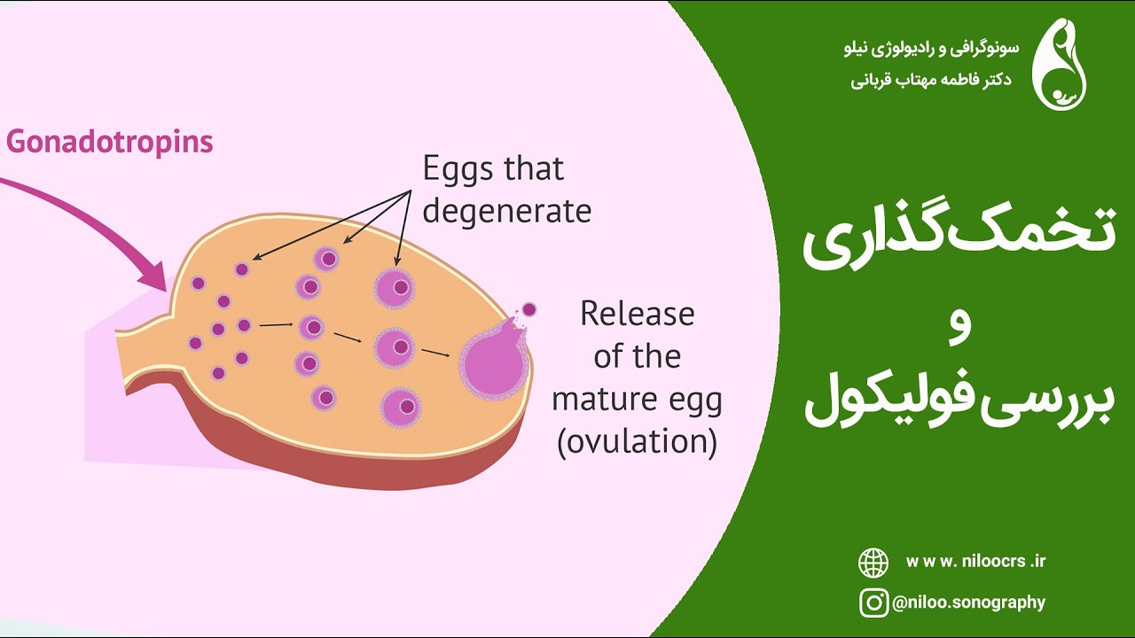 سونوگرافی تخمدان و بررسی فولیکول