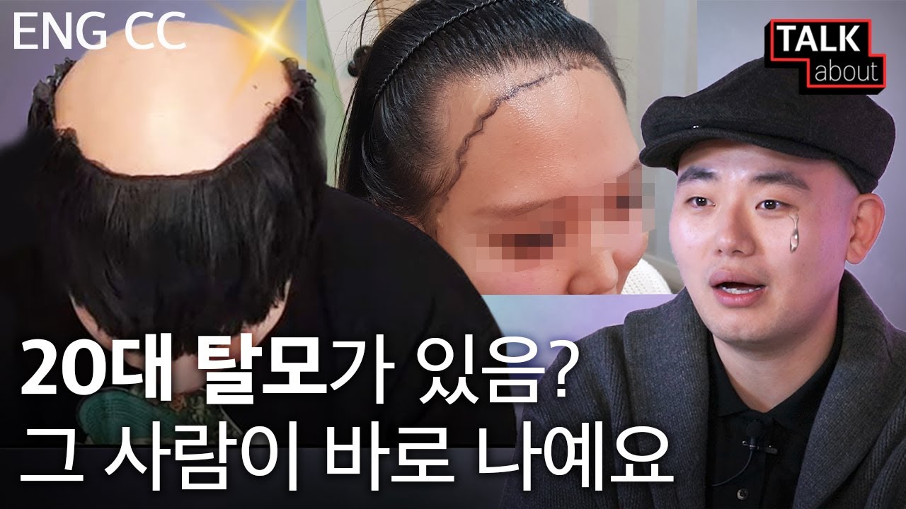 20대에 갑자기 찾아온 탈모 때문에 겪었던 일 [톡어바웃: 탈모 편]