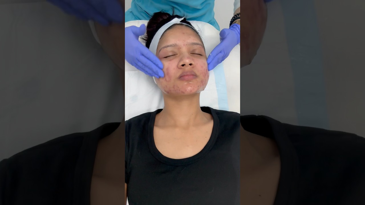 Chemical peel done. #acnetreatment #chemicalpeel #mandalicpeel #acnescars #acnechemicalpeel