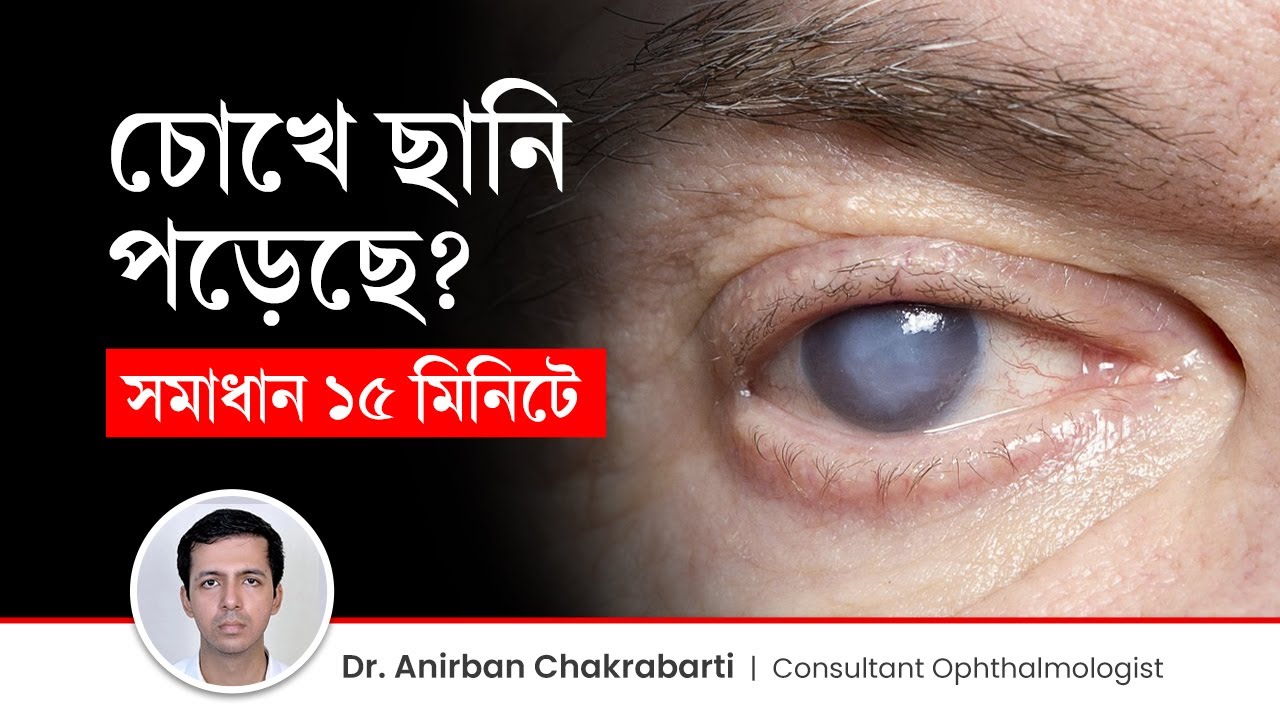 চোখে ছানি পড়েছে কিভাবে বুঝবেন? কিভাবে ছানি অপারেশন করে? Cataracts Causes, Symptoms & Treatments