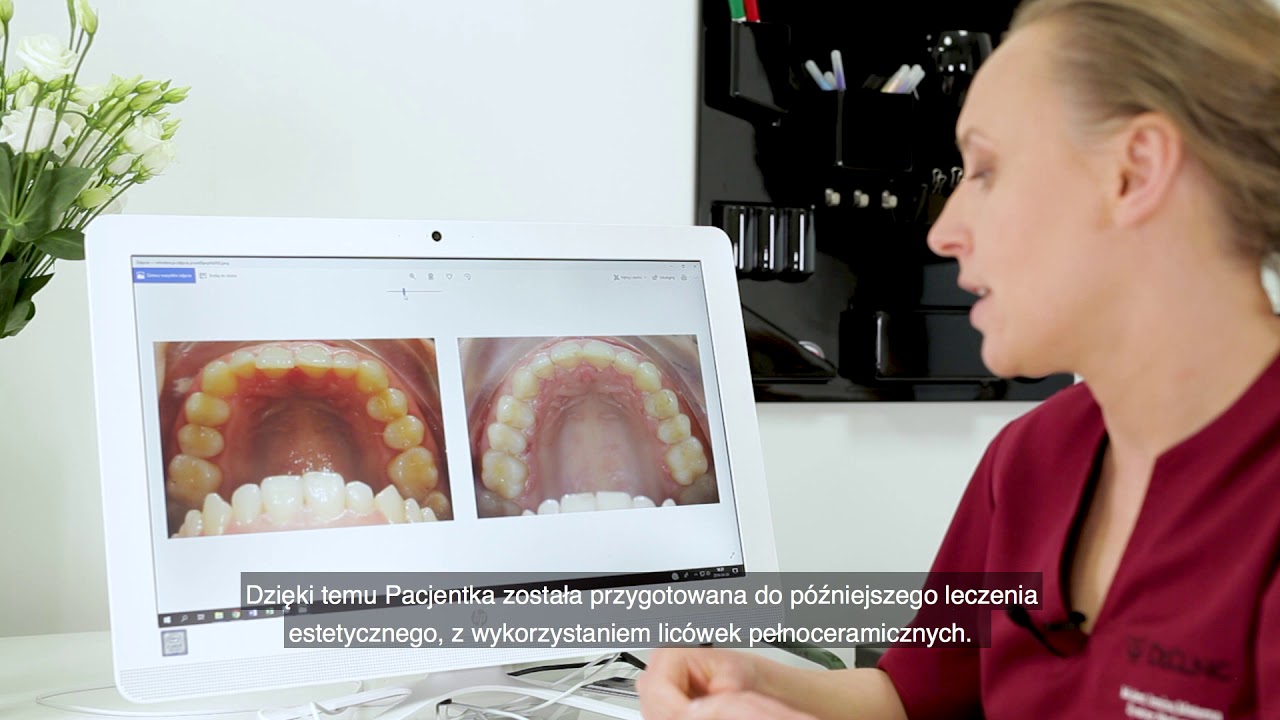 ⭐ Efekty leczenia ortodontycznego w DeClinic ✨