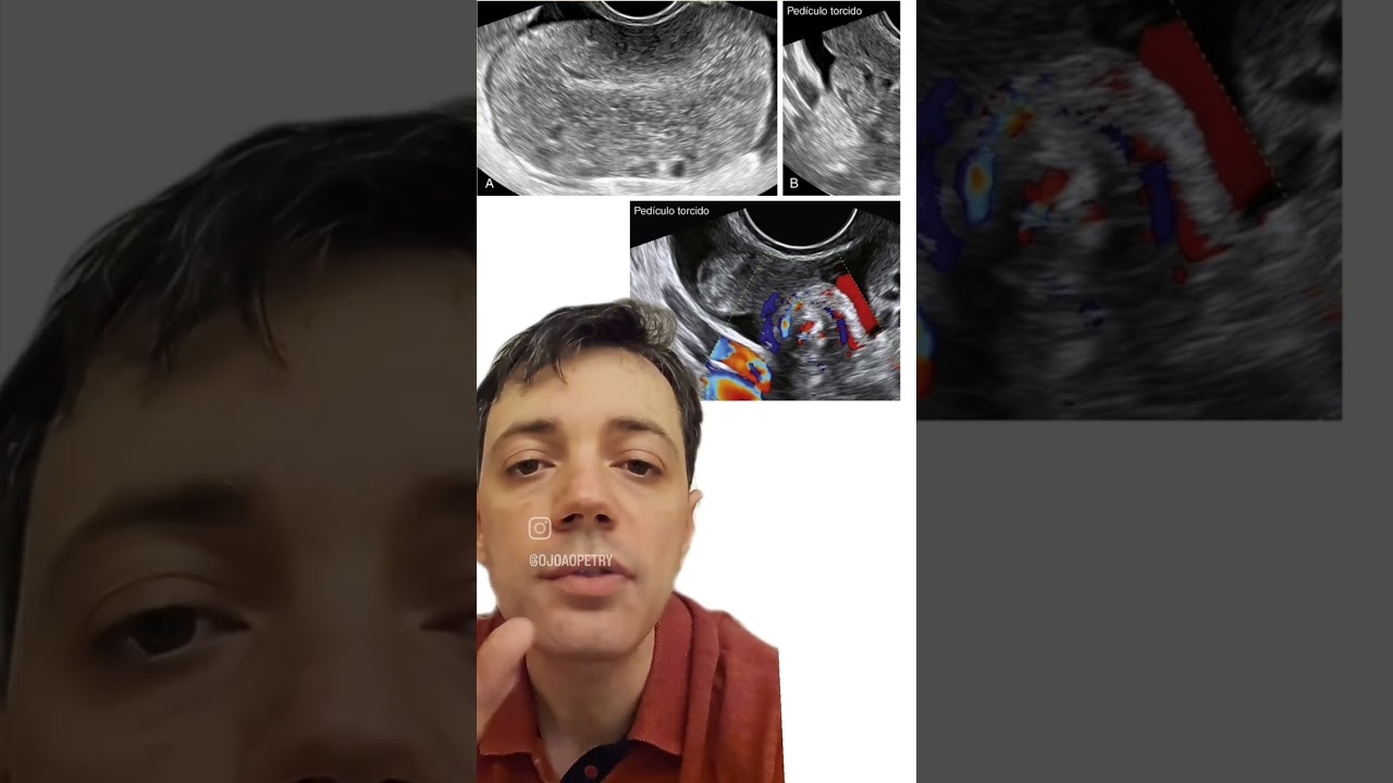 Ultrassom transvaginal de A a Z Letra T Tor&ccedil;&atilde;o Ovariana