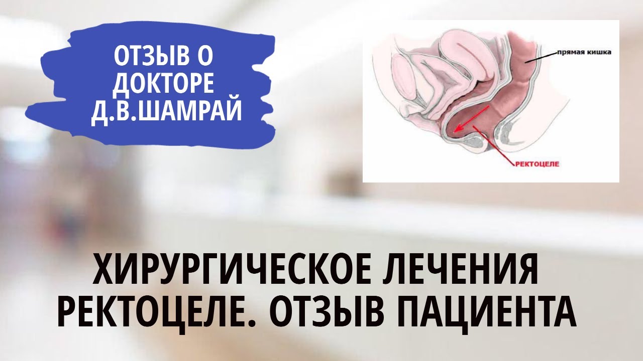 Хирургическое лечения ректоцеле. Отзыв