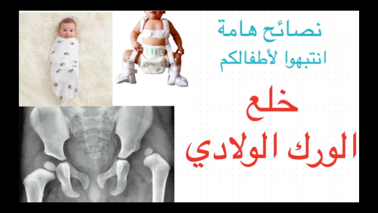 Hip Dysplasia / نصائح مفيدة  لعلاج خلع الورك الولادي. انتبهوا لأطفالكم