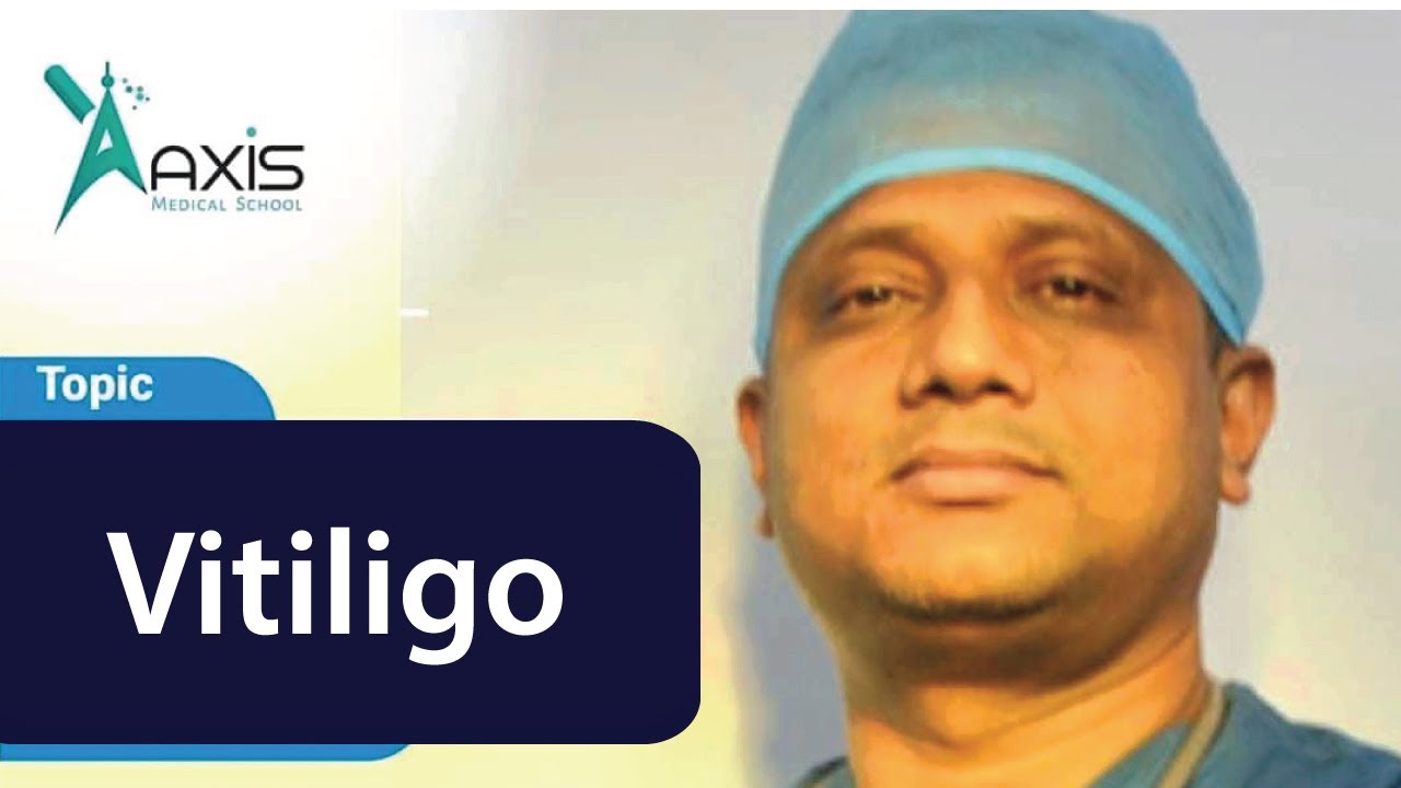 Vitiligo