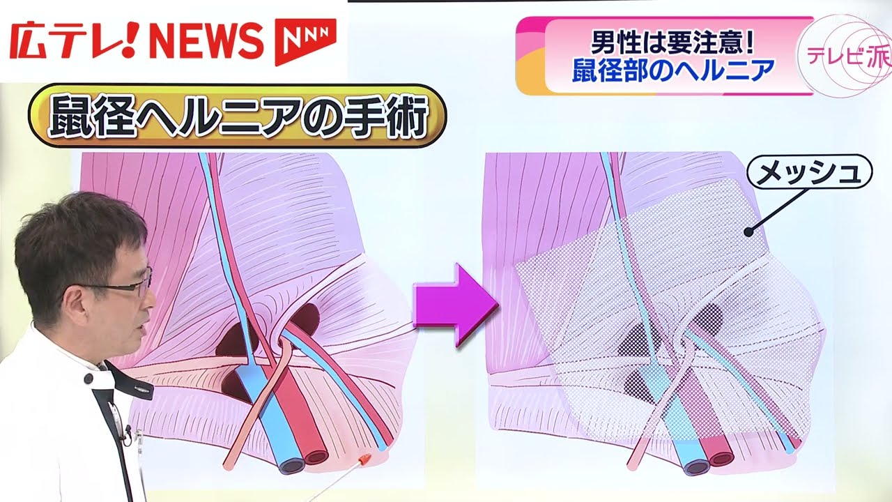 男性は要注意！【鼠径ヘルニア】とは？【テレビ派・かけこみクリニック】