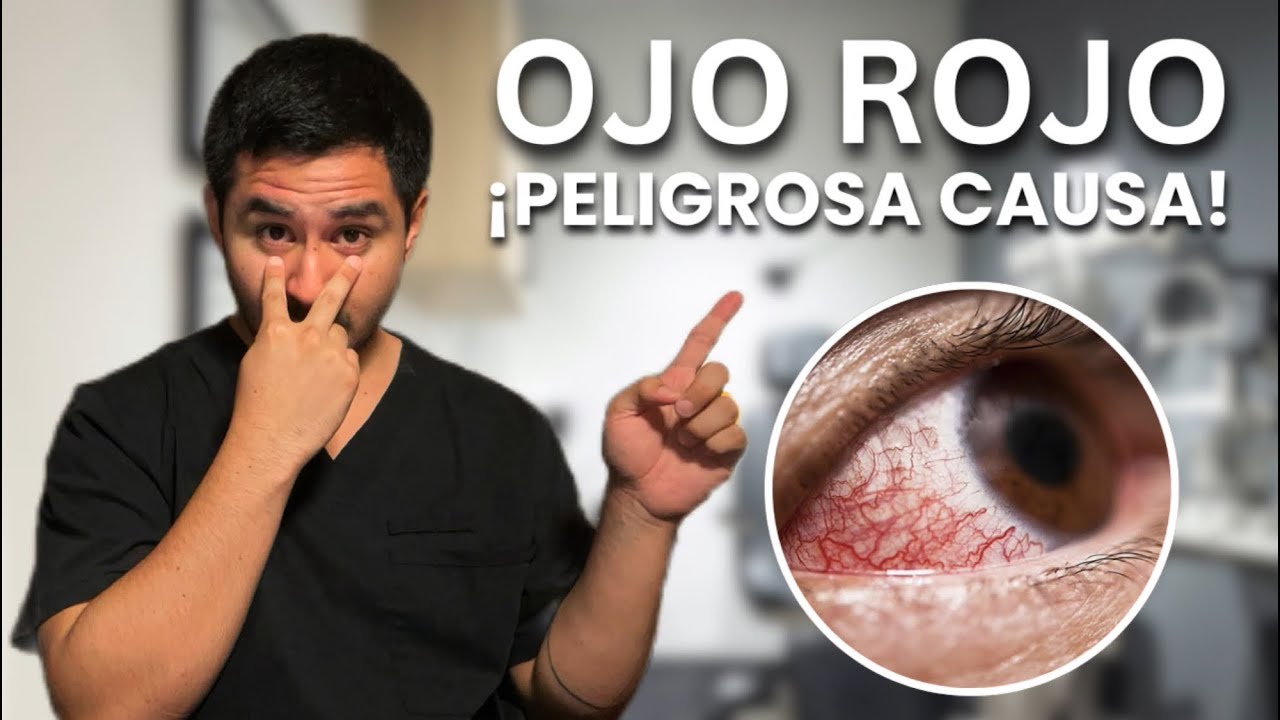 Diferencias entre Escleritis y Epiescleritis (OJO ROJO): S&iacute;ntomas, Causas y Tratamientos