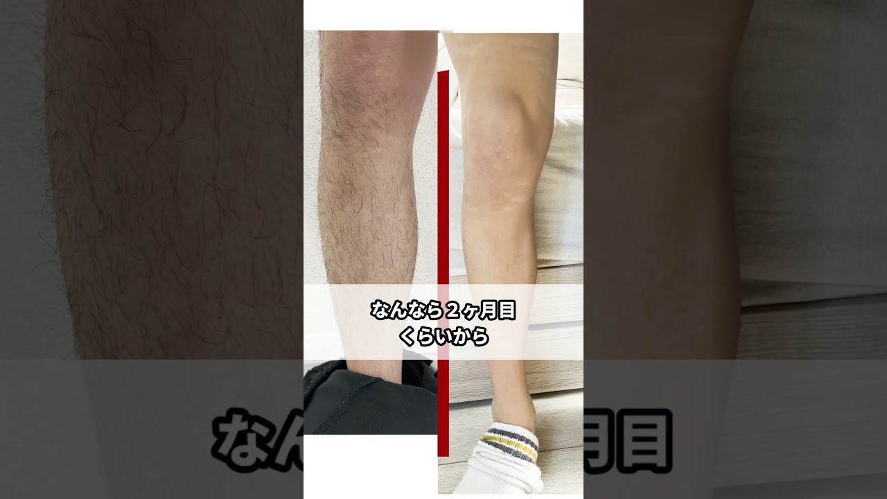 家庭用脱毛を１年ガチでやってみた結果ww #ケノン #脱毛 #脱毛器