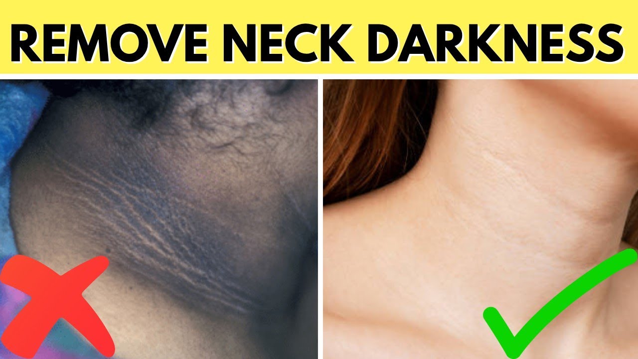 Remove Dark Neck Fast 😱| Ghar Pe 1 Din Me Gala Kaala Se Safed 🤯| 100% Natural Remedy!🚨