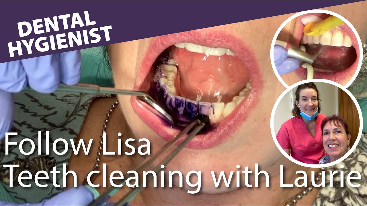 🦷 Invisalign 32 - Getting my teeth cleaned by the dental hygienist // Follow Lisa