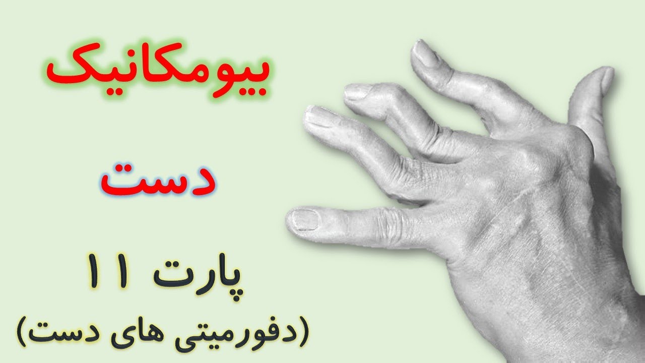 دفورمیتی های دستِ بیماران روماتیسم مفصلی (بیومکانیک دست) از کینزیولوژی نیومن