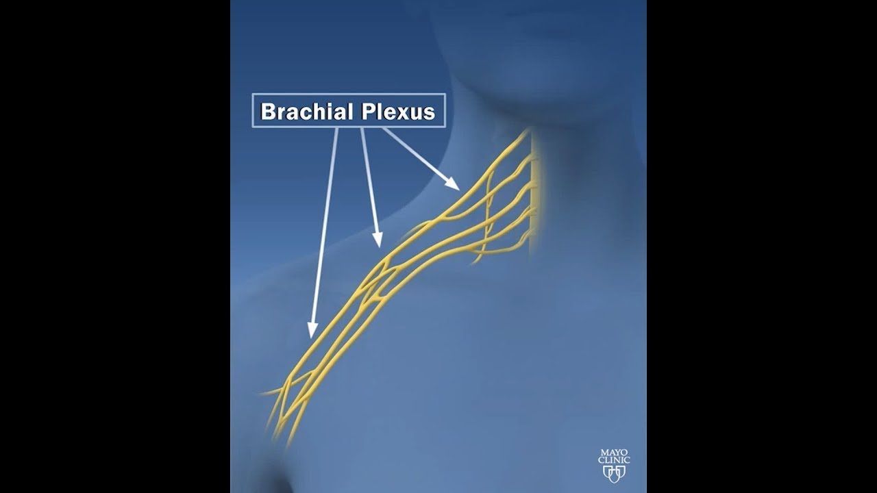 Dr. Shelley Noland - Explains what the Brachial Plexus is and how a severe injury can be treated.