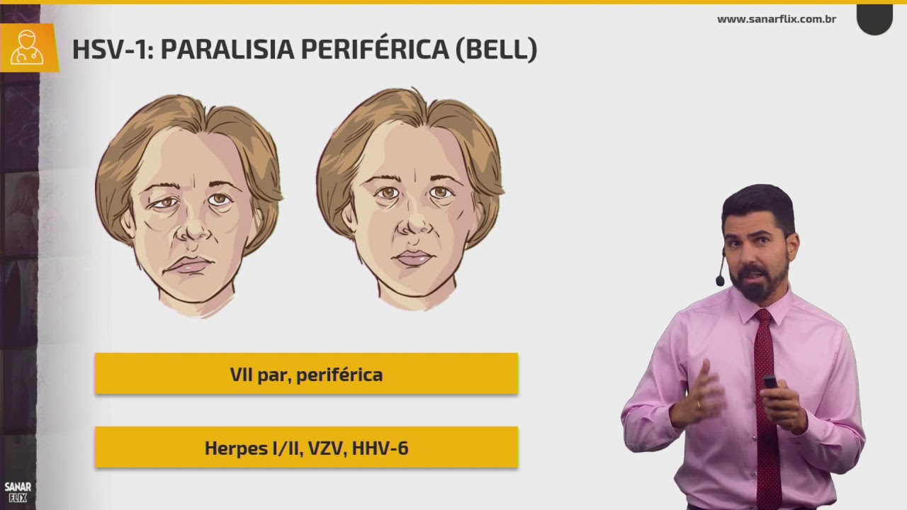 Herpes vírus - Doenças sexualmente transmissíveis - Infectologia - Aula SanarFlix