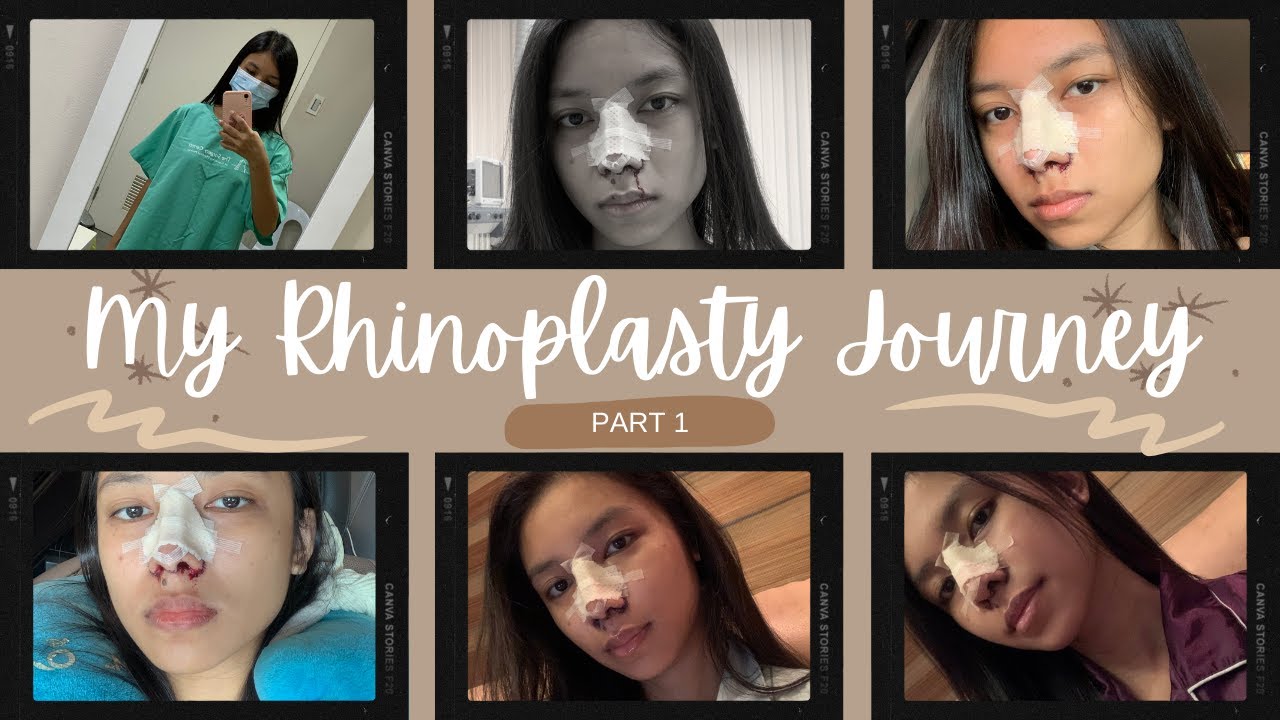 RHINOPLASTY JOURNEY PART 1 | DOC NATO PASCUAL | Shayrie Wynne | Philippines