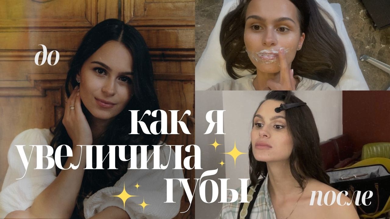 КАК Я УВЕЛИЧИЛА ГУБЫ: РЕАКЦИЯ РОДНЫХ | ОТЕКИ И ВОССТАНОВЛЕНИЕ | РЕЗУЛЬТАТ СПУСТЯ 10 МЕСЯЦЕВ