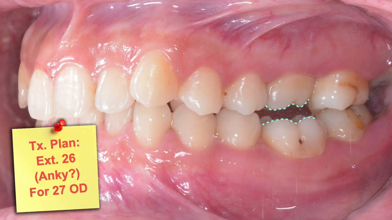Treatment Plan Discussion：Class I Deep Bite｜【Chris Chang Ortho】CC722