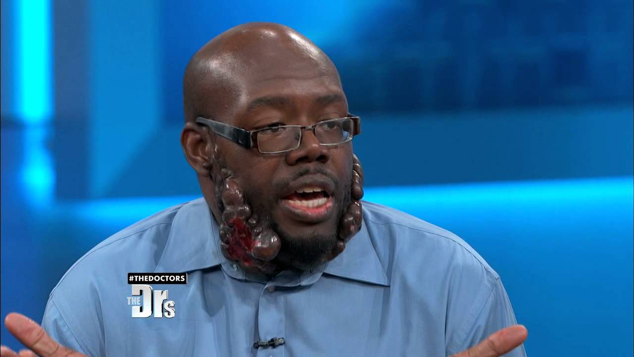 Man with Keloids Reveals Obstacle to Treatment